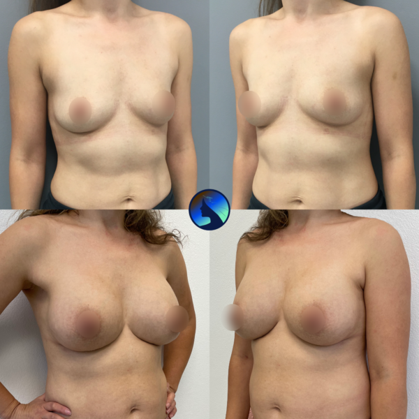 Implanty piersi po latach