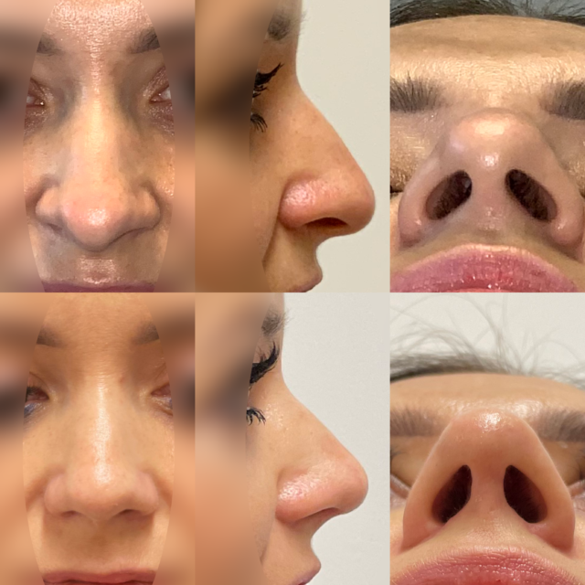Template Rhinoplasty Tip Only and Still Excision