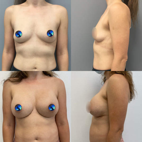 implanty piersi przez pachę po latach