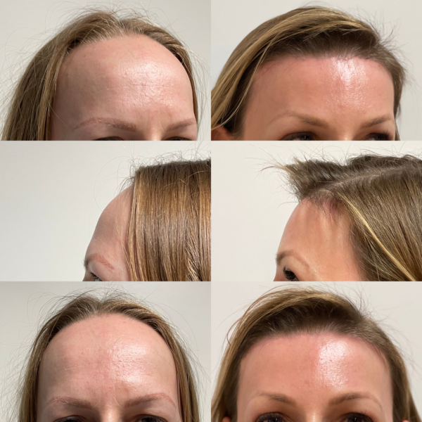 Brow Lift + Hairline Lowering