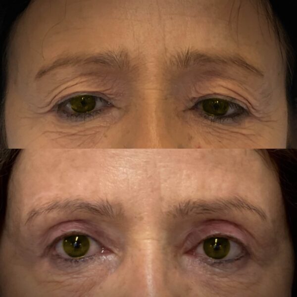 Direct Brow Lift with Blepharoplasty