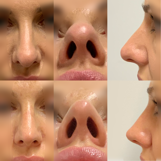 nose tip secondary rhinoplasty