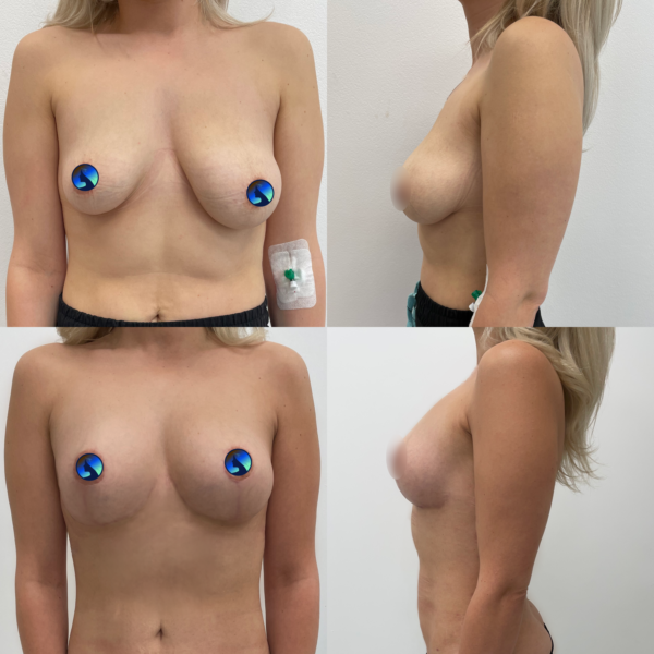 Breast Symmetrization