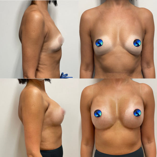 Endoscopic breast augmentation with logo