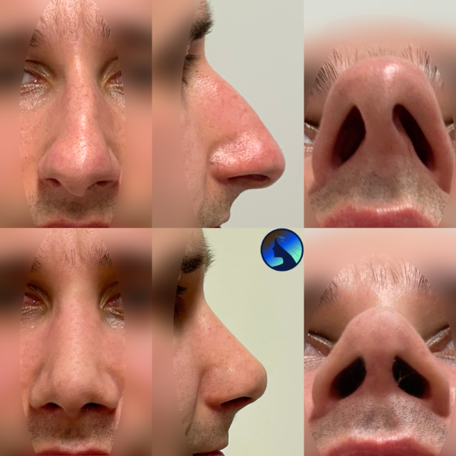 Piękny prosty nos