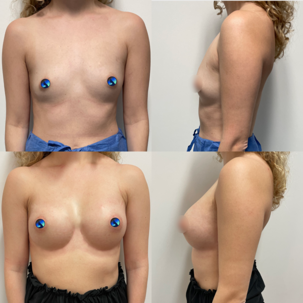 Endoscopic transaxillary breast augmentation