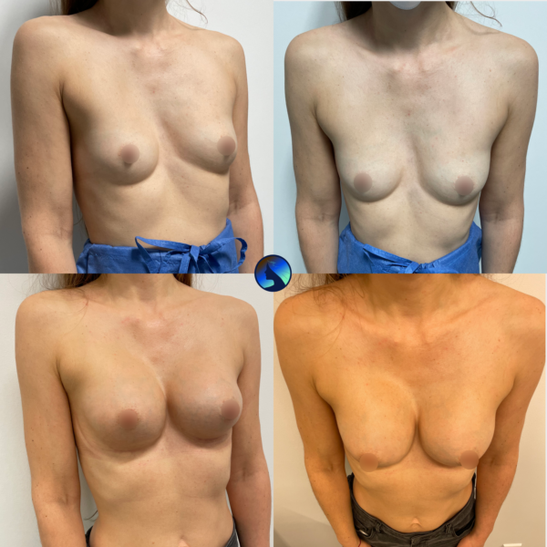 Chest Asymmetry Correction nipples covered