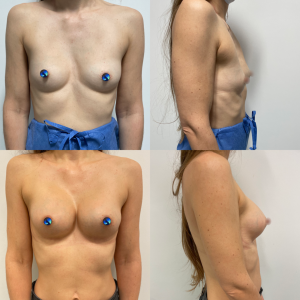 Chest asymmetry coved nipples