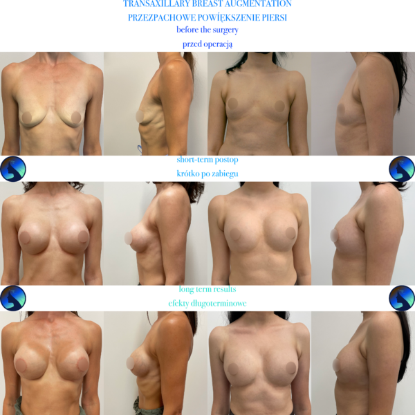 Breast Augmentation Long term results