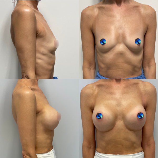 Endoskopowe powiększanie piersi u 60-cio latki