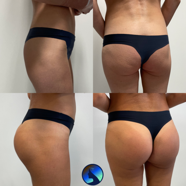 Gluteal Implants