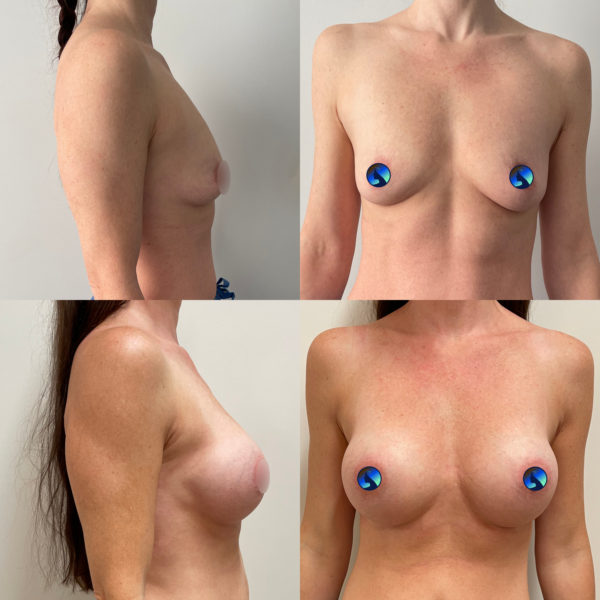 Sexy transaxillary Breast Augmentation