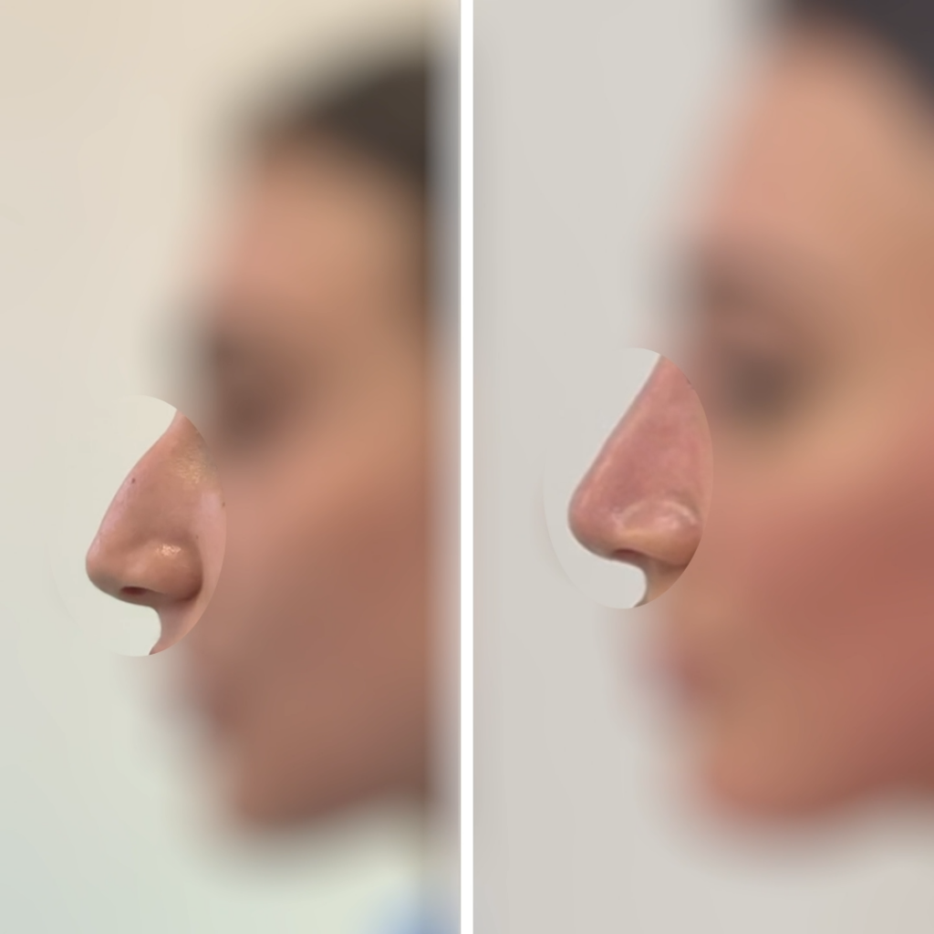 korekcja nosa i uszu przykład nr 1